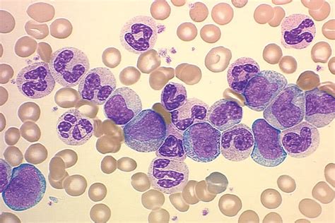 ارتفاع neutrophils في الدم